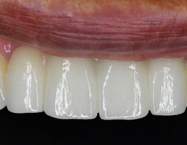 Crown and Bridge After