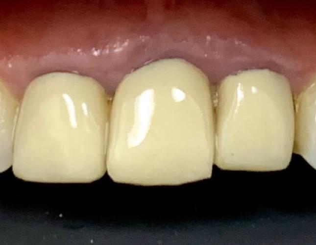Crown and Bridge Before