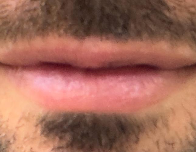 Cyst Removal 1 After