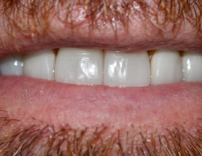 Cyst Removal 2 After