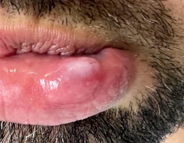 Cyst Removal 1 Before