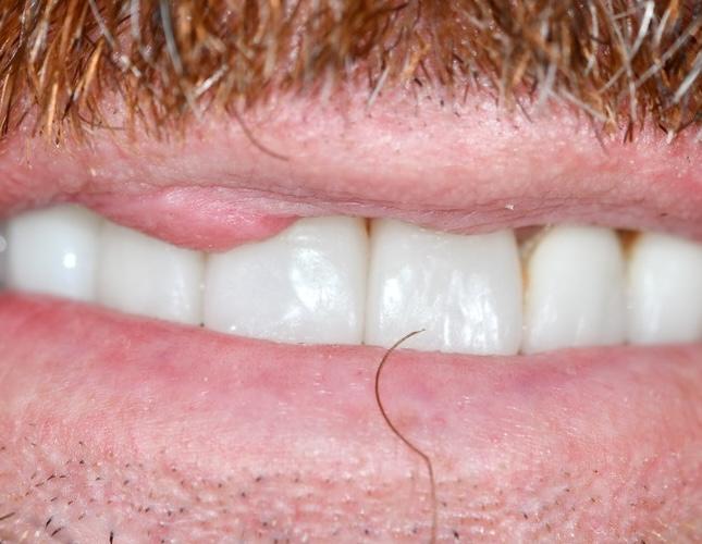 Cyst Removal 2 Before