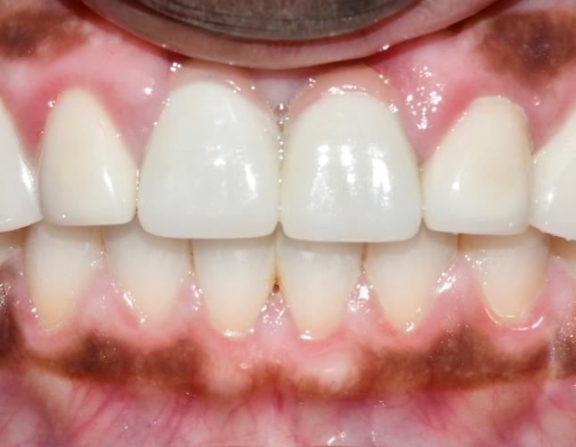 Full Mouth Restoration 5 After