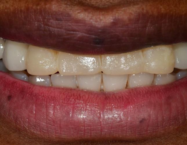 Full Mouth Restoration 5 Before