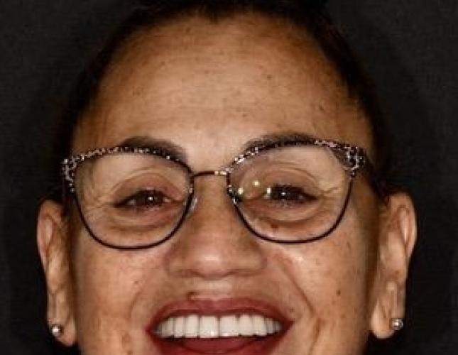 Full Mouth Restoration 6 After