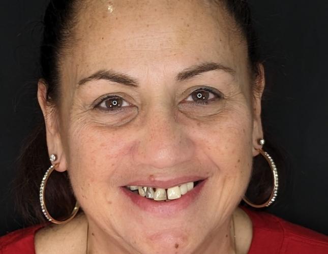 Full Mouth Restoration 6 Before