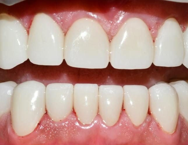 Full Mouth Restoration 3 After