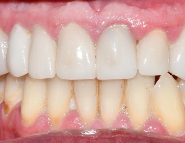 Full Mouth Restoration 4 After