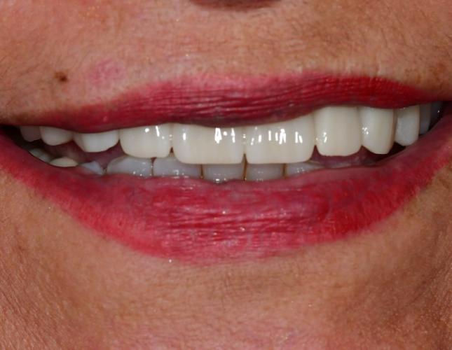 Full Mouth Restoration 7 After