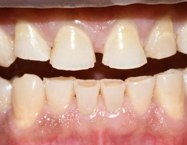 Full Mouth Restoration 3 Before