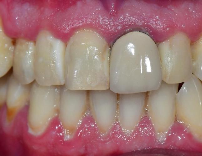 Full Mouth Restoration 4 Before