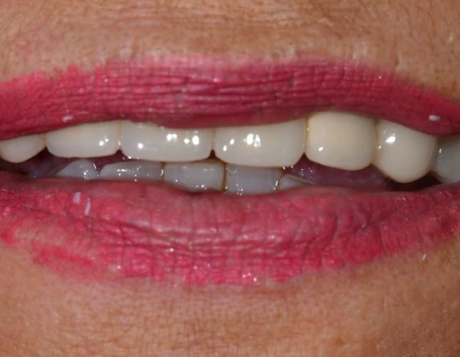 Full Mouth Restoration 7 After
