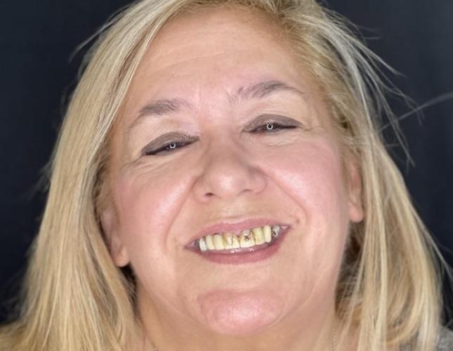 Full Mouth Restoration 2 Before