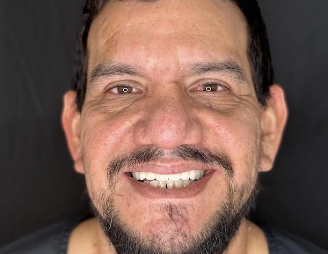 Full Mouth Restoration 1 After