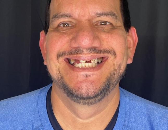 Full Mouth Restoration 1 Before