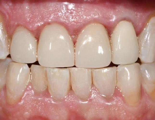 Implant and Crown After