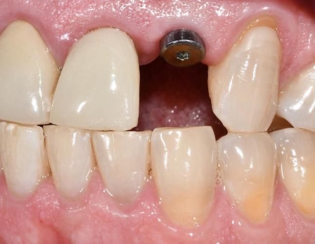 Implant and Crown Before