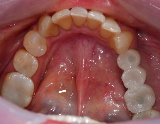 Implant Bridge After