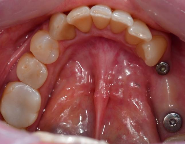 Implant Bridge Before