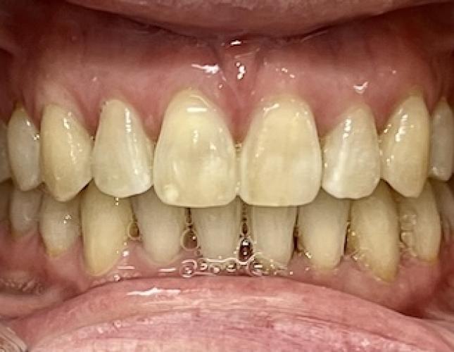 Invisalign 7 After