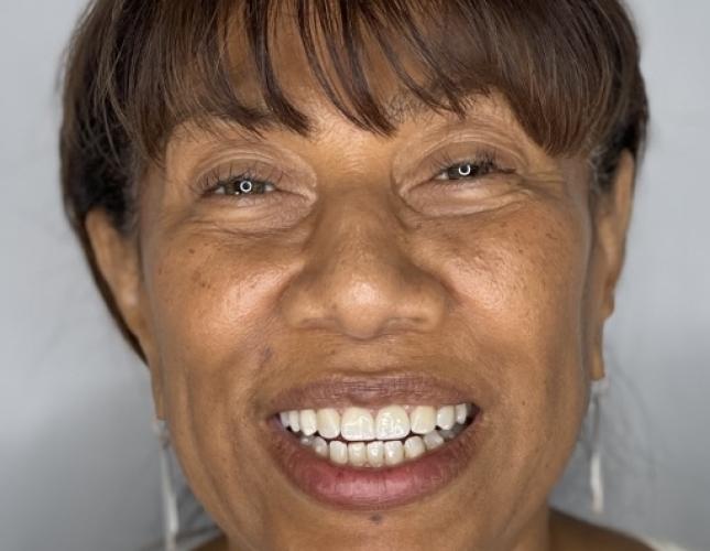 Invisalign & Bridges after