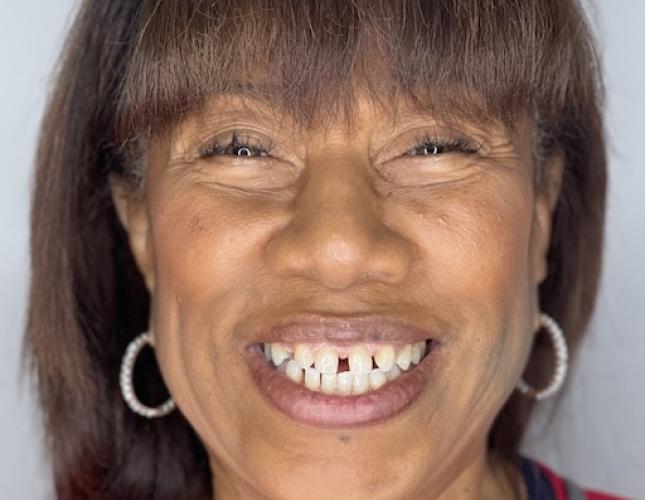 Invisalign & Bridges before