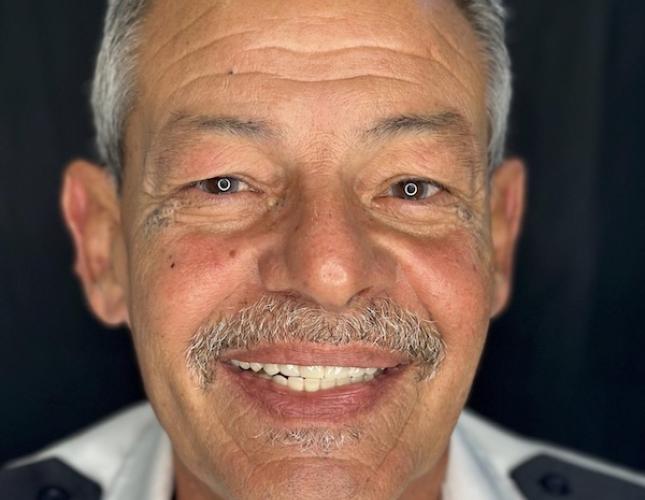 Snap-On Dentures 6 After