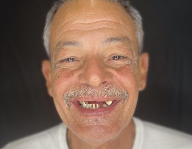 Snap-On Dentures 6 Before