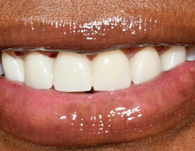 Upper Bridge 5 After