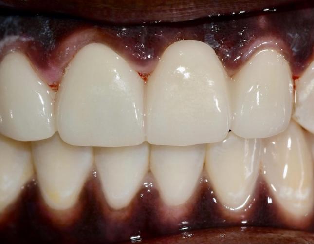 Upper Bridge 6 After