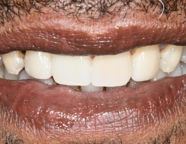 Upper Bridge 7 After