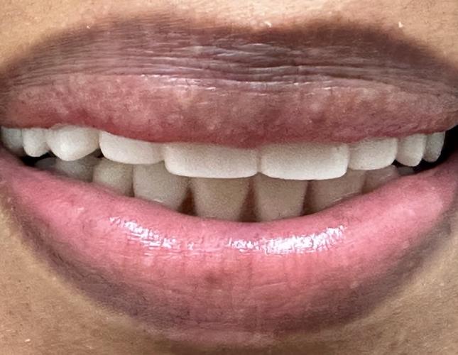 Upper Bridge 8 After