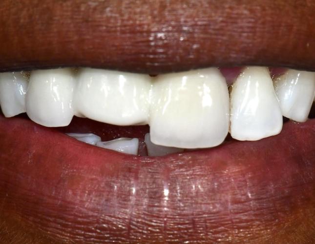 Upper Bridge 5 Before