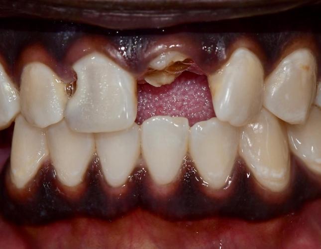 Upper Bridge 6 Before