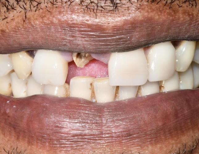 Upper Bridge 7 Before