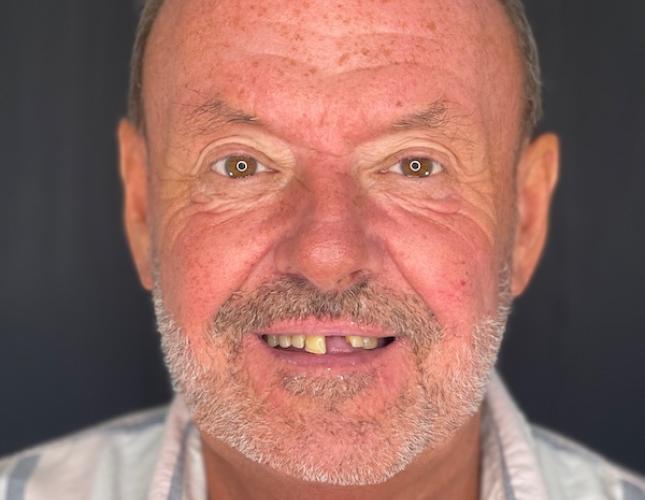 Upper Bridge 3 Before