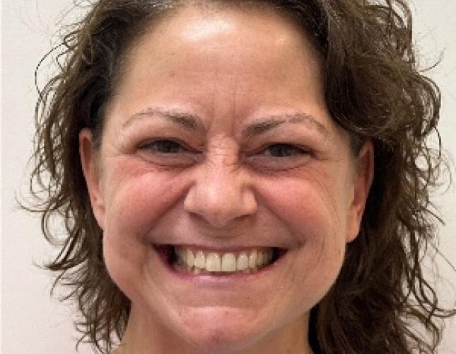 Invisalign and Veneers Before