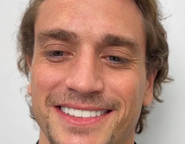 Full Set of Veneers After