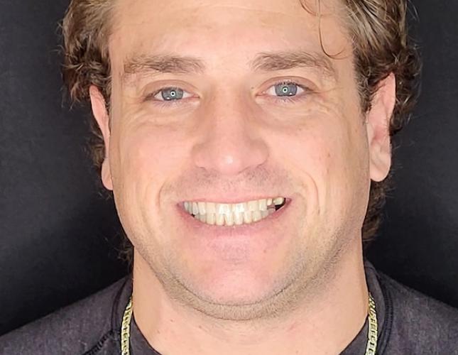 Full Set of Veneers Before