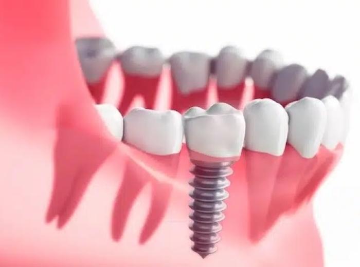 What Is The Recovery Process For Dental Implants?