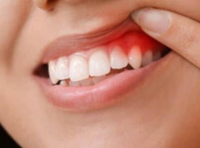 5 Tricks to Stop Gum Disease Before it Starts