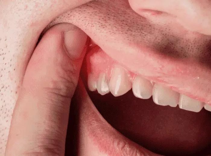 Seeking Treatment for an Abscessed Tooth: What Can an Emergency Dentist Do?