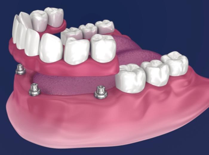 4 Essential Considerations Before Choosing All-on-4 Implants