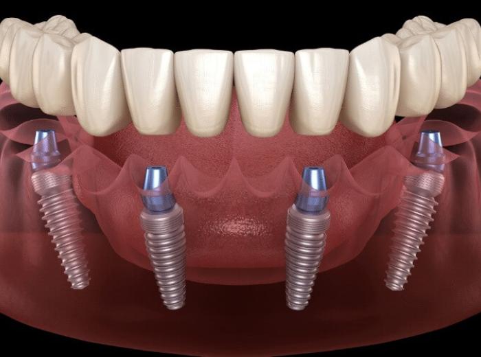 5 Reasons To Choose All-on-4 Implants