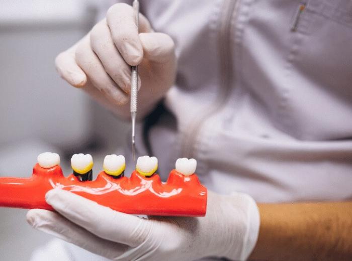 Breaking Myths and Misconceptions About All-on-4 Implants