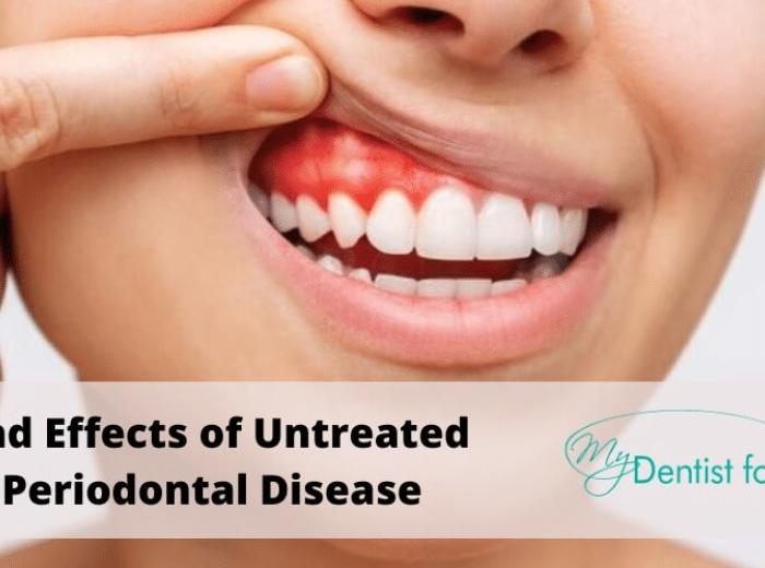 What Happens When Periodontal Disease Remains Untreated?