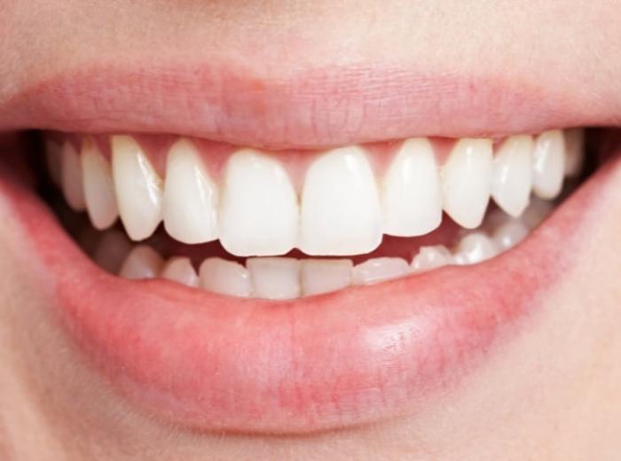 What Are Black Triangles Between Your Teeth?