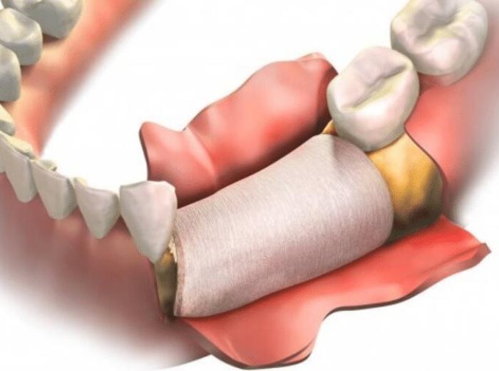 What Should You Know About Bone Grafting?