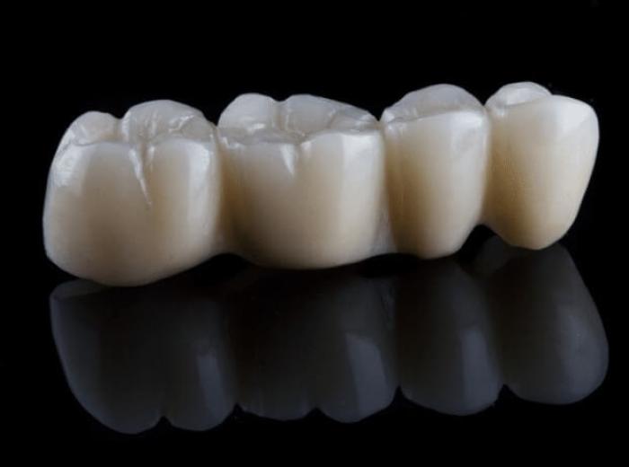 Caring For Porcelain Bridges: Dentist’s Tips For Long-Term Success