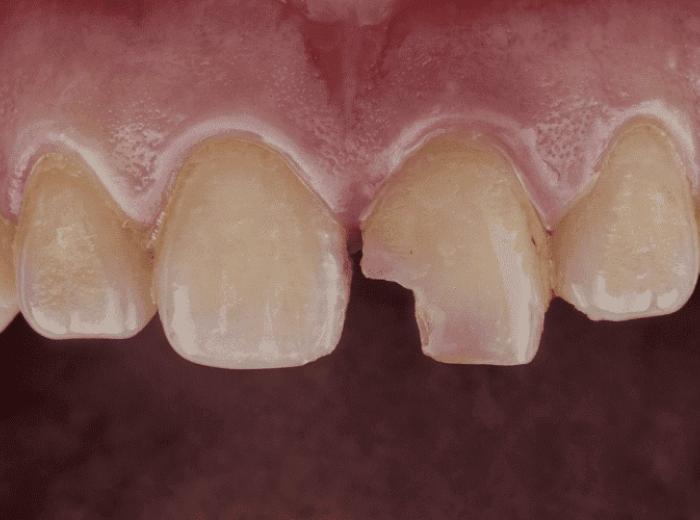 Chipped Tooth: Immediate Steps and Treatment Options